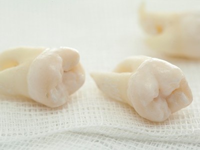 智齒疼了，這牙非拔不可嗎？