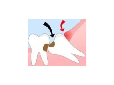 吃完飯后老塞牙？別大意！這可能是你的牙齒在報(bào)警