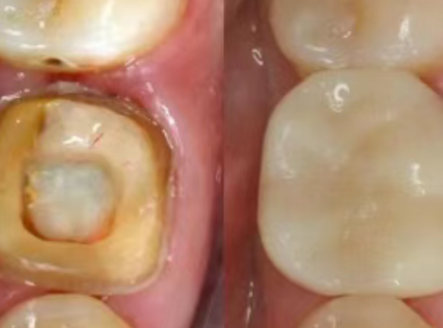 根管治療（抽神經(jīng)）后，為什么一定要做牙冠？