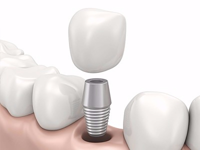 在承德哪家口腔醫(yī)院口腔種植齒好一點，惟德口腔醫(yī)院值得您的選擇