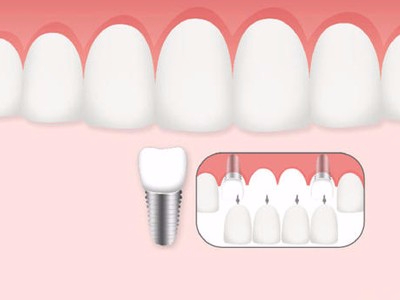 惟德口腔口腔種植怎么樣？惟德口腔就來為您一一解答