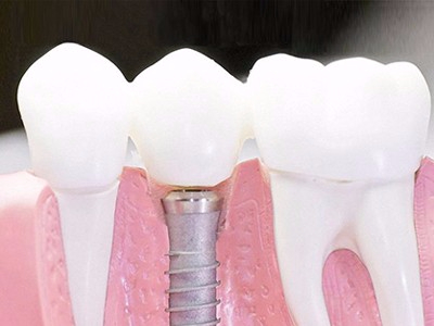 在承德口腔種植齒需要多少錢？惟德口腔一一為您道來