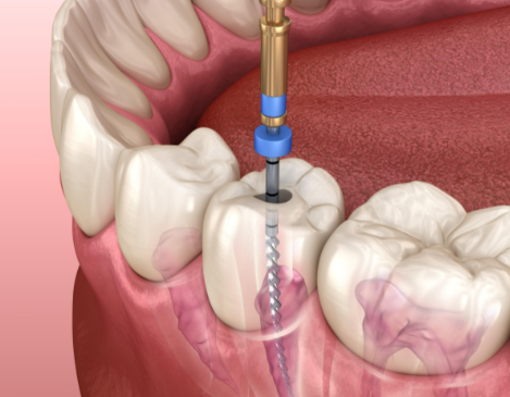 根管治療后的注意事項(xiàng)有哪些？